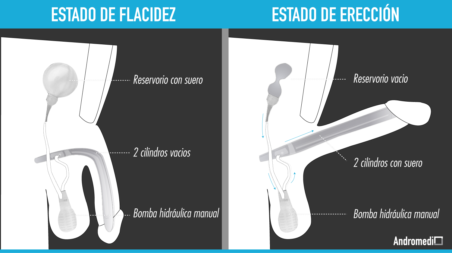 ¿Como funciona la protesis de pene?